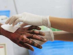 Tiga Bulan Menderita Luka Bakar, Bocah di Konawe Selatan Butuh Bantuan