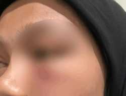 Jadi Korban Kekerasan Dua Seniornya, Mahasiwi UHO Alami Luka Lebam hingga Memar
