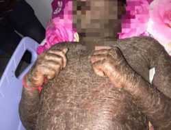 Pria Asal Bombana Alami Kulit Bersisik Usai Konsumsi Obat Pemutih dan Antibiotik