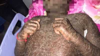 Pria Asal Bombana Alami Kulit Bersisik Usai Konsumsi Obat Pemutih dan Antibiotik