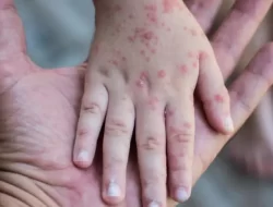 Kemenkes Sebut Jumlah Kasus Cacar Monyet Terus Bertambah