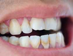 6 Cara Efektif Menghilangkan Kerak Gigi, Boleh Dicoba di Rumah