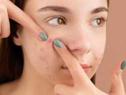 Sebaiknya Dihindari, Ini 8 Jenis Makanan Penyebab Jerawat Bisa Muncul