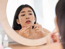 Berikut Ini Penyebab Munculnya Jerawat di Wajah