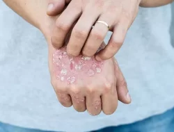 Sulawesi Tenggara Tempati Daftar Provinsi dengan Prevelensi Kusta Tertinggi di Indonesia